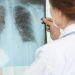 Día Mundial de la Tuberculosis 2021,recomiendan prestar atención a la tos