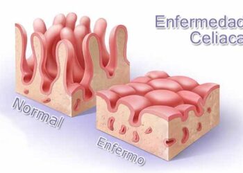 Desentrañando la Enfermedad Celíaca: De la Patogénesis a la Medicina de Precisión