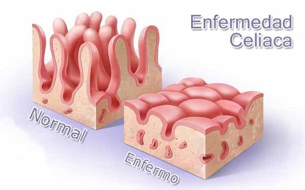 Desentrañando la Enfermedad Celíaca: De la Patogénesis a la Medicina de Precisión